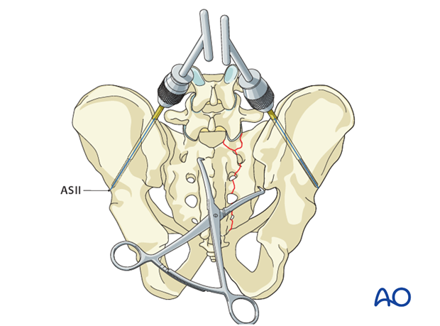 spinopelvic fixation