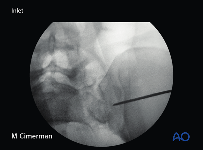 ISS fixation for C0 Nondisplaced U-fracture
