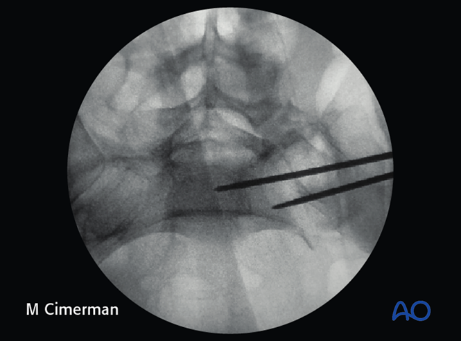 ISS fixation for C0 Nondisplaced U-fracture