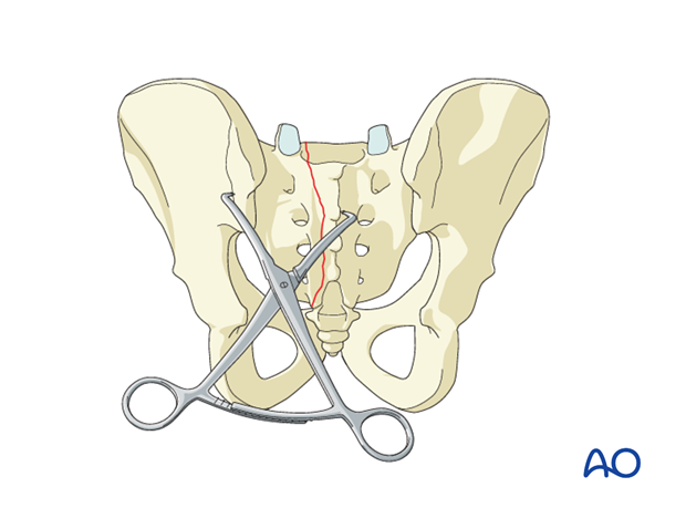 iss fixation