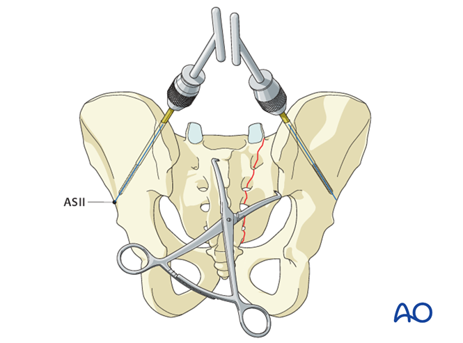ISS fixation for B3 Transforaminal fracture