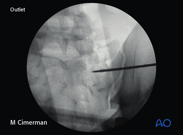 iliosacral screw insertion