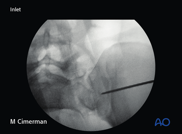 iliosacral screw insertion