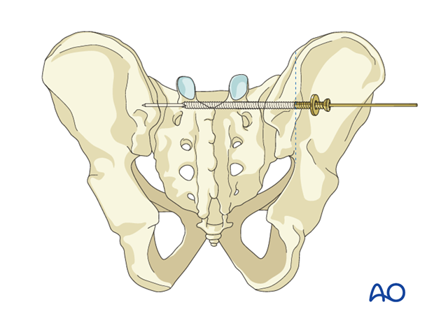 iliosacral screw insertion