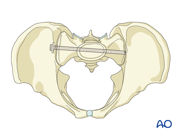 iliosacral screw insertion