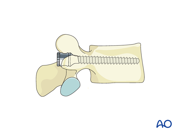 insertion of the pedicle screws
