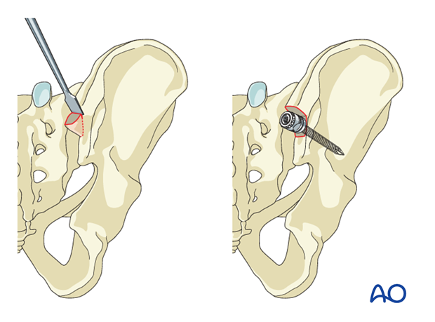 The traditional entry point for iliac screws.