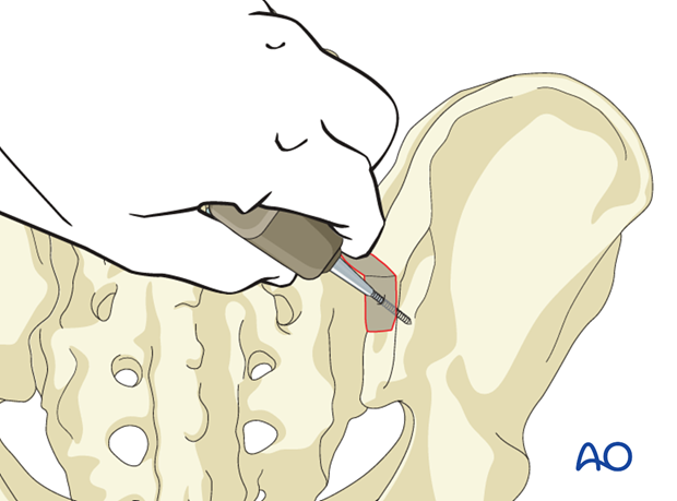 An awl is used to penetrate between the two cortices in a ventral, caudal direction toward the anterior inferior iliac spine during iliac screw insertion at the traditional entry point.