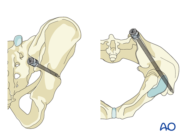 The anatomic entry point for iliac screws.