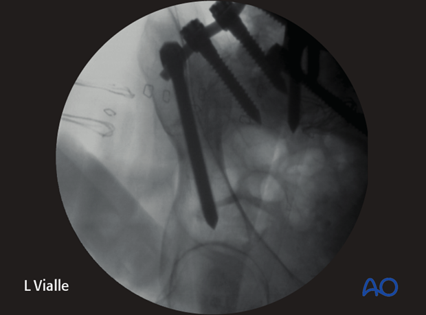 The obturator inlet view is perpendicular to the iliac screw trajectory.