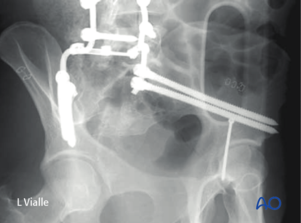 The iliac oblique view is perpendicular to the ilium and can be used to verify iliac screw position and length.