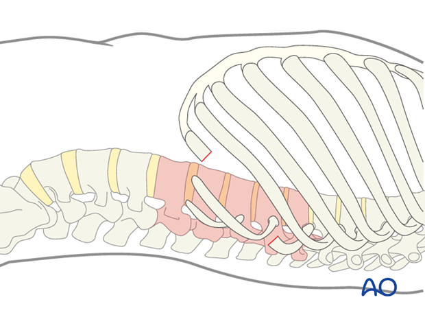 anterior approach to the lumbar spine