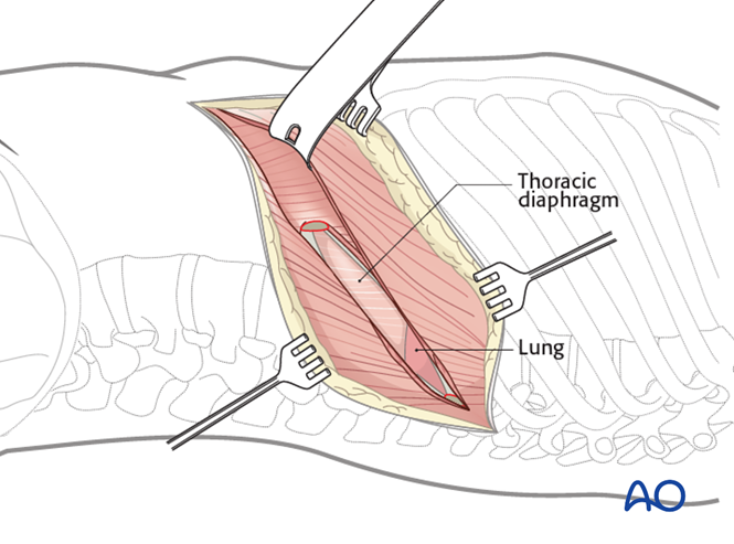 Anterior approach to the lumbar spine