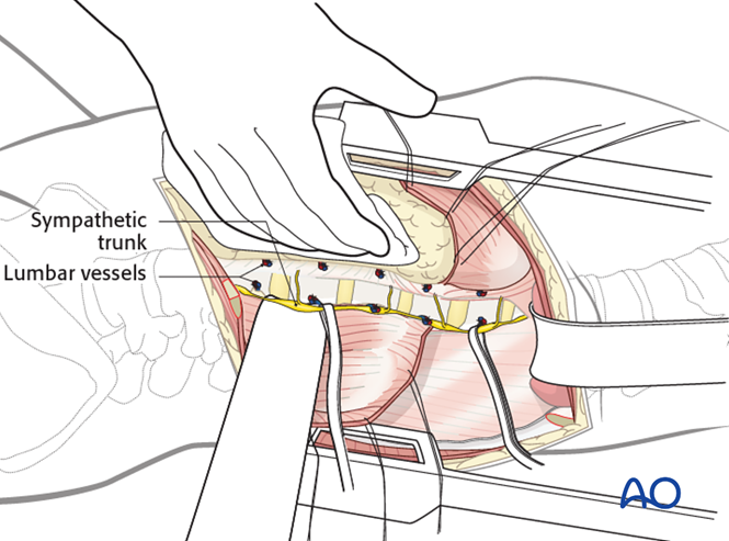 Anterior approach to the lumbar spine