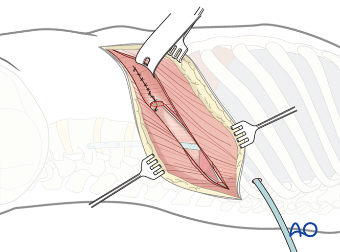 Anterior approach to the lumbar spine