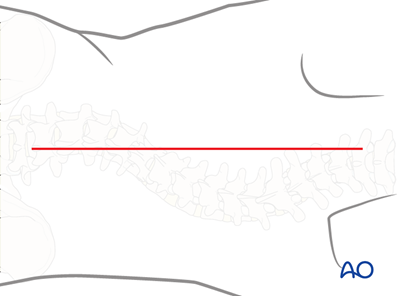 Posterior approach