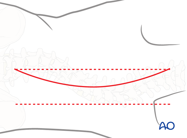 posterior approach