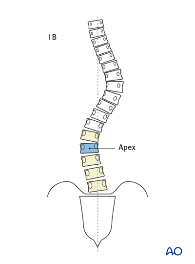 Lenke classification