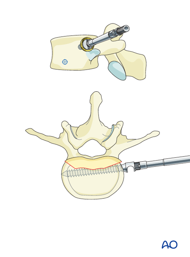 AIS Lenke 5 Pedicle screw placement posterior screw