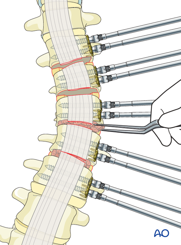 AIS Lenke 5 Grafting of lumbar spine