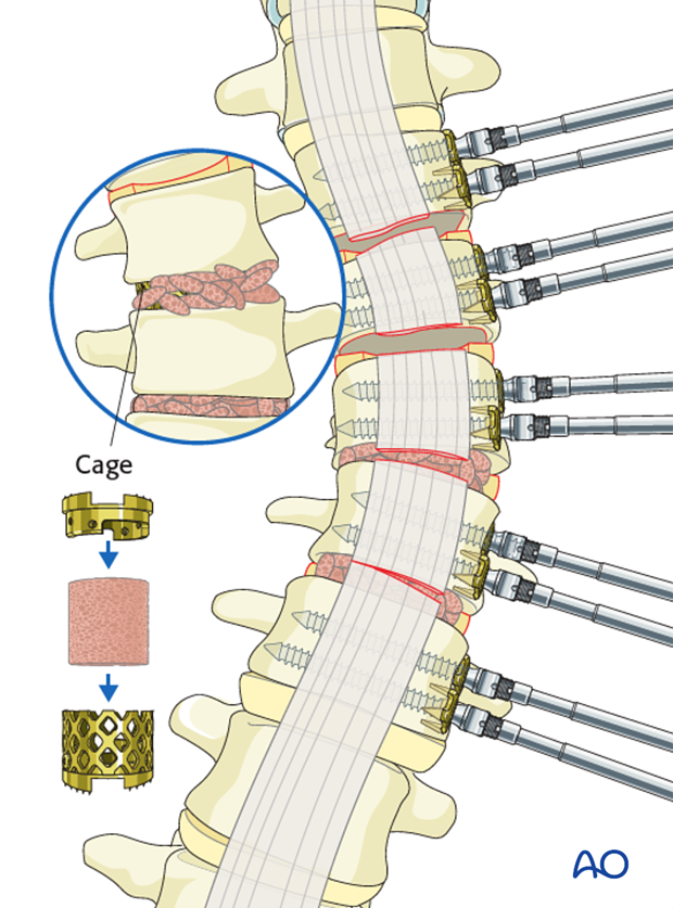 AIS Lenke 5 Grafting of lumbar spine placement of cage