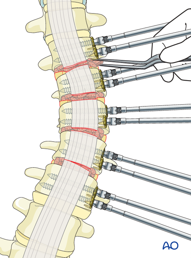 AIS Lenke 5 Grafting of thoracic spine