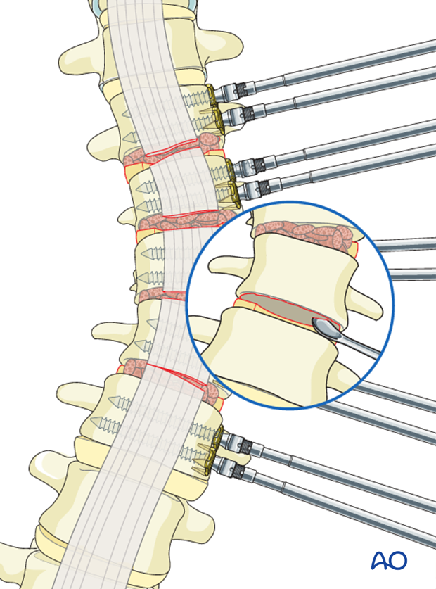 AIS Lenke 5 Grafting of lumbar spine pitfall