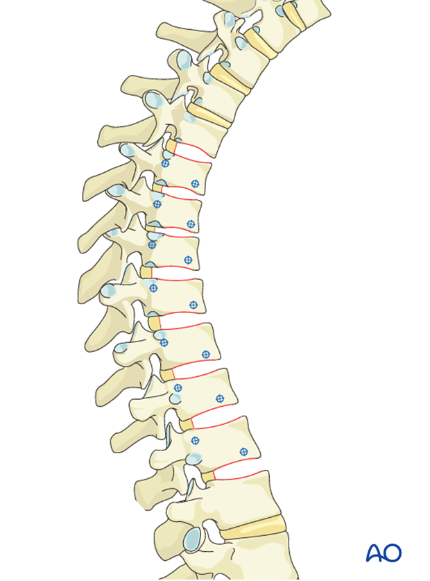 AIS Lenke 1 Anterior surgery Selection of fusion levels