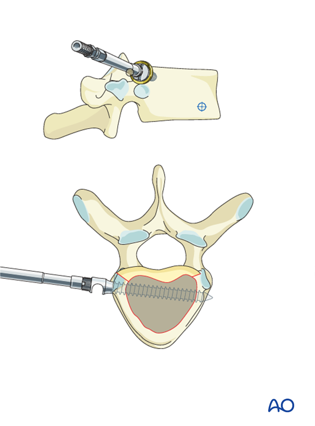 AIS Lenke 1 Anterior surgery Posterior screw