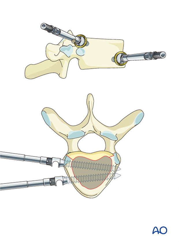 AIS Lenke 1 Anterior surgery Anterior screw