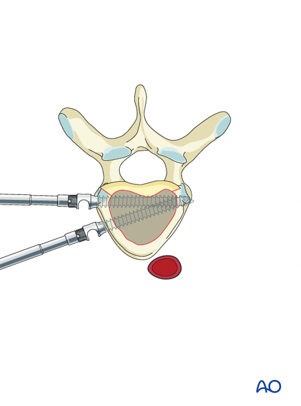 AIS Lenke 1 Anterior surgery Anterior screw pitfall