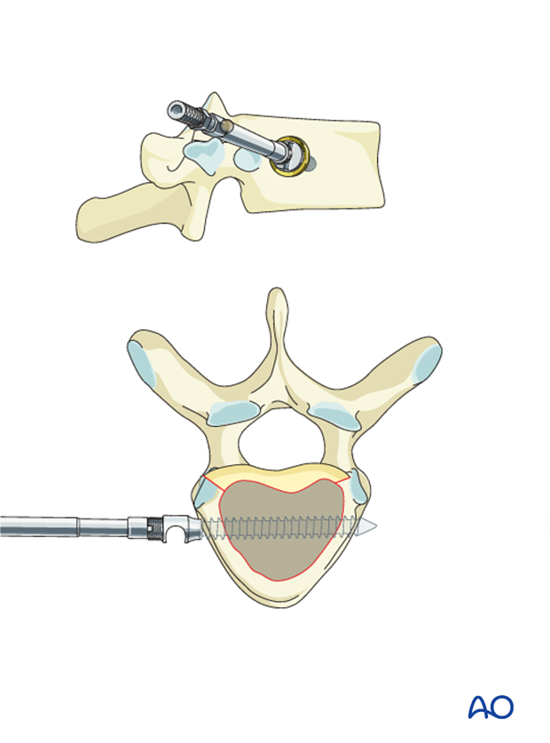 AIS Lenke 1 Anterior surgery Single scrwe placement