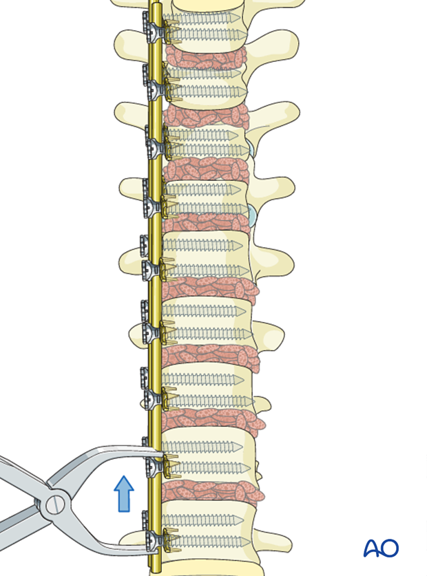 AIS Lenke 1 Anterior surgery Rod insertion compression