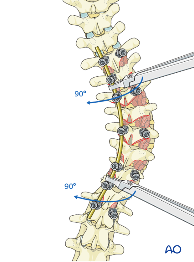 AIS Lenke 1 Posterior pedicle screws - Correction of deformity