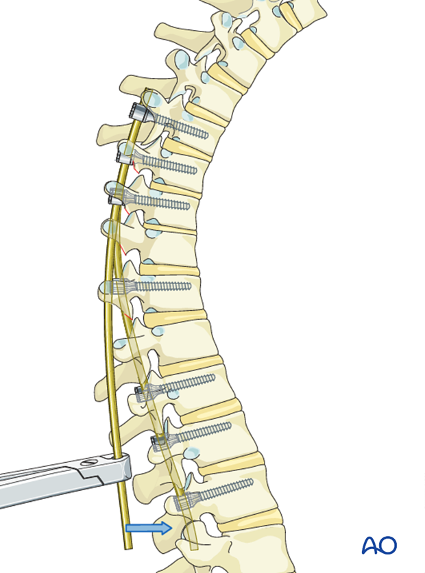 AIS Lenke 1 Posterior pedicle screws - Rod insertion