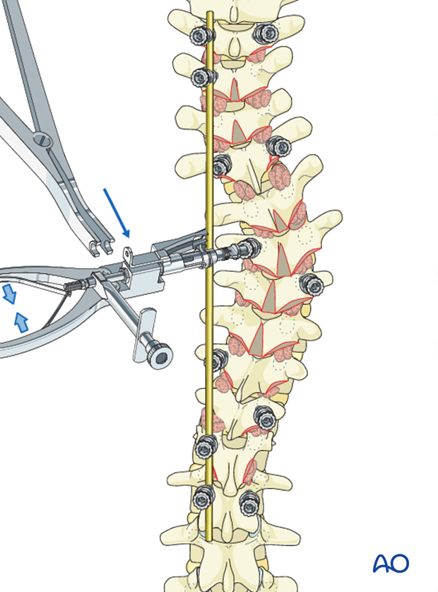 AIS Lenke 2 Posterior pedicle screws - Compression and distraction