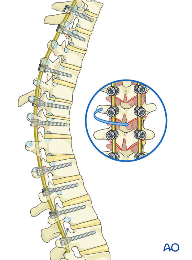 AIS Lenke 2 Posterior pedicle screws - Derotation of apical segments