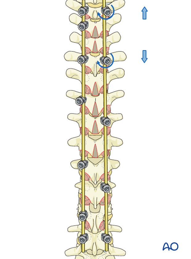 AIS Lenke 2 Posterior pedicle screws - Distraction of the concavity of the PTC