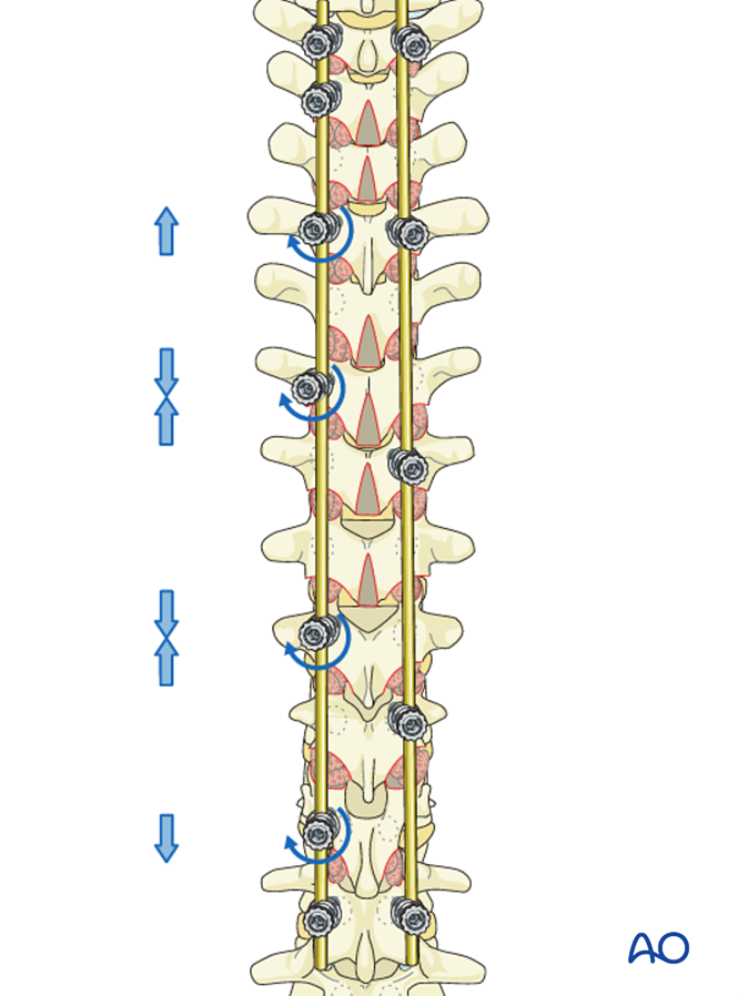 Posterior Screws - No direct vertebral body derotation for Lenke 2