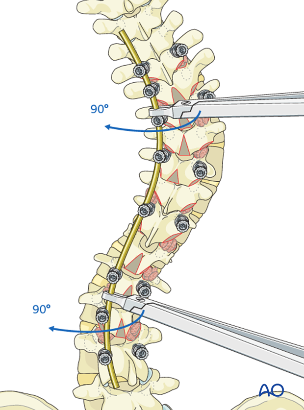 AIS Lenke 3 Posterior pedicle screws - Rod rotation