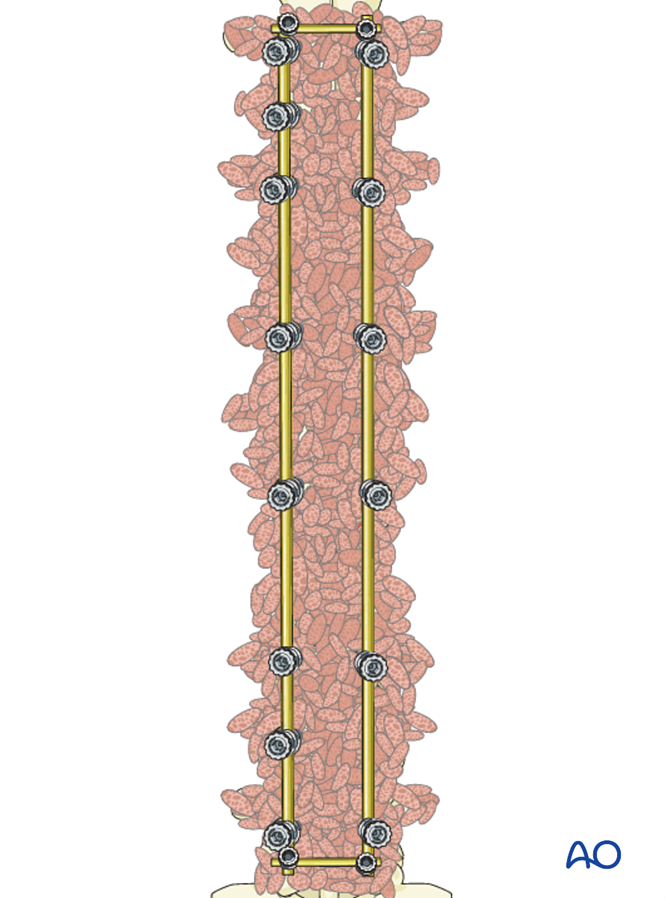 Posterior Screws - With direct vertebral body derotation for Lenke 6