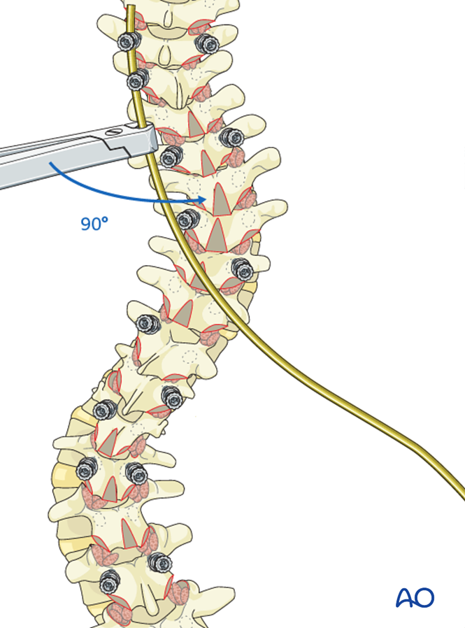 Posterior Screws - No direct vertebral body derotation for Lenke 4