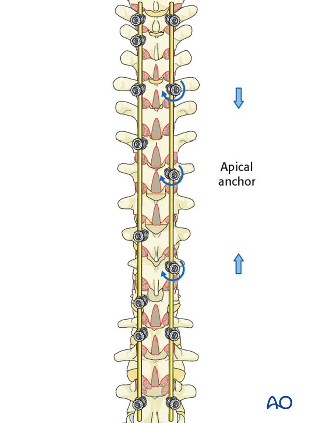 AIS Lenke 4 Posterior pedicle screws - Compression