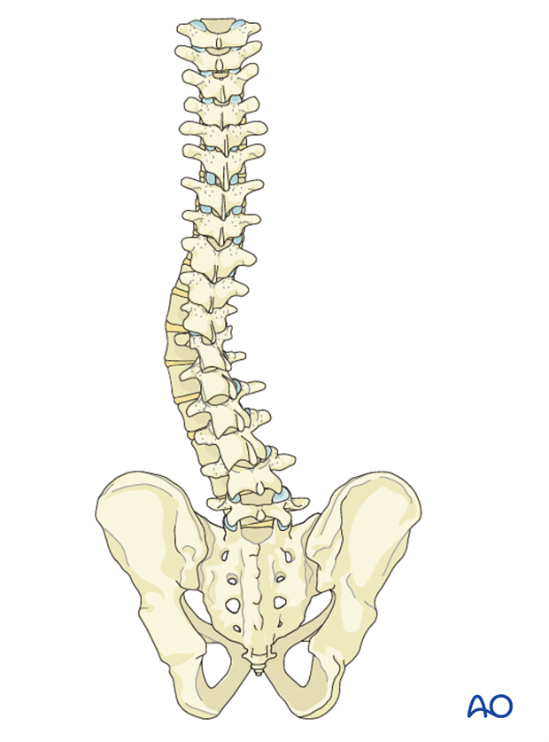 AIS Goal of surgery Lenke 5