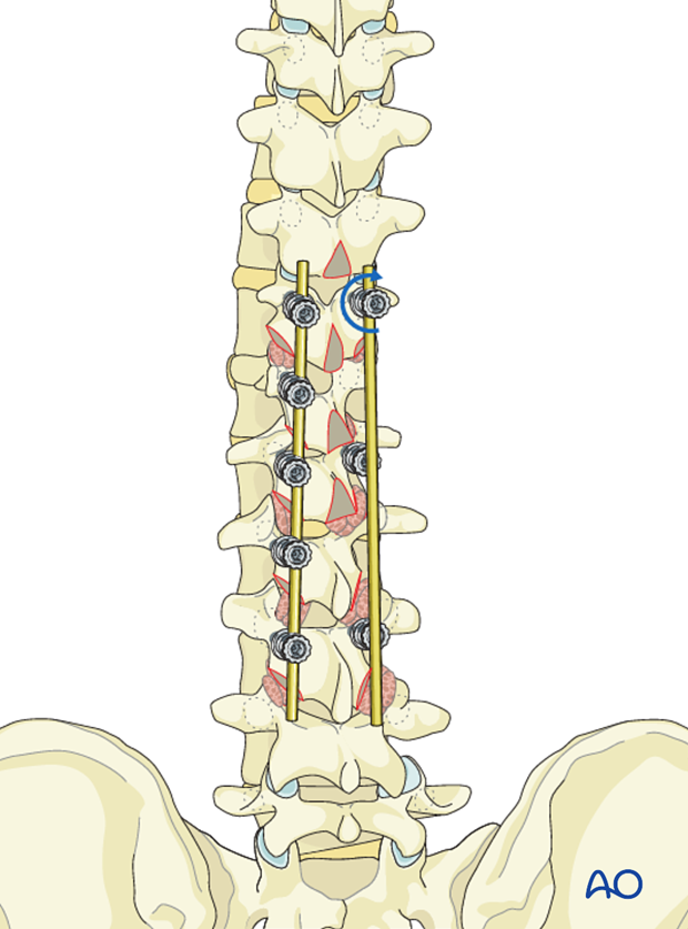 posterior screws no direct vertebral body derotation