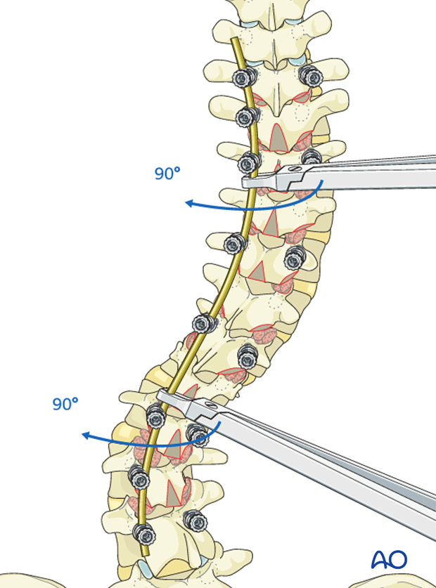 AIS Lenke 6 Posterior pedicle screws - Rod rotation