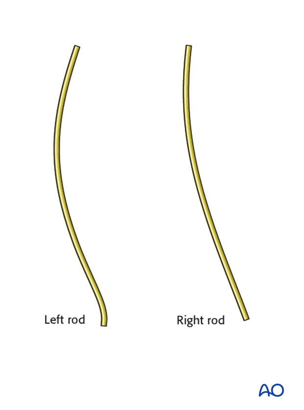 AIS Lenke 5 Posterior pedicle screws - Rod bending