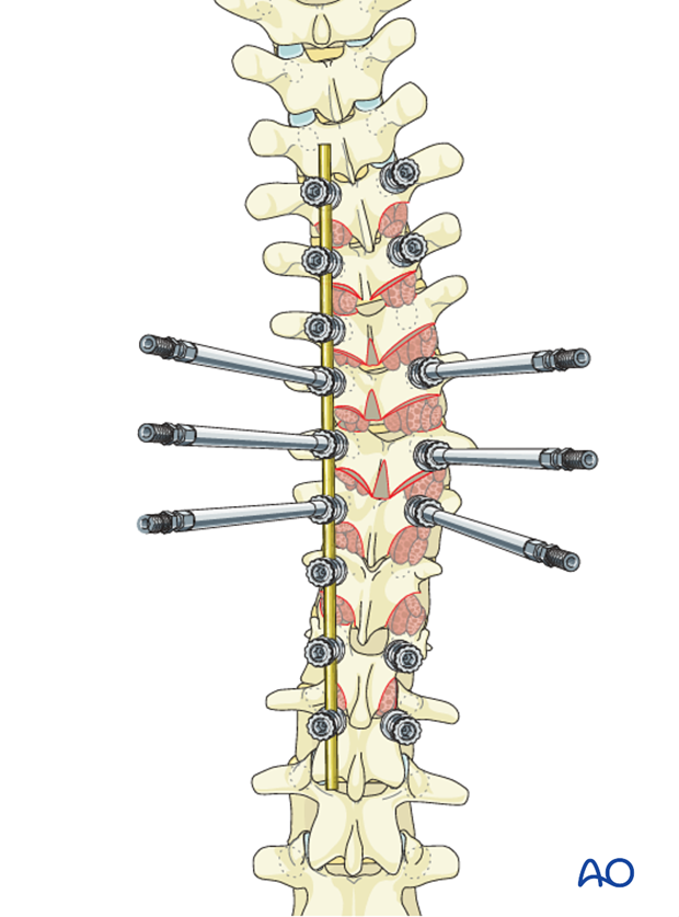 AIS Lenke 1 Posterior pedicle screws - Derotation of the spine