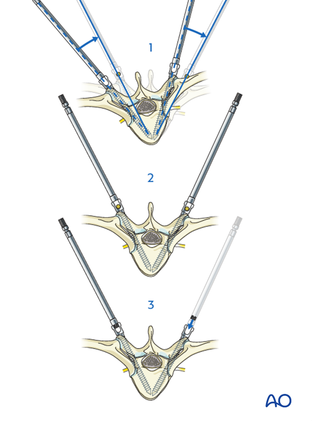 AIS Lenke 1 Posterior pedicle screws - Apical derotation