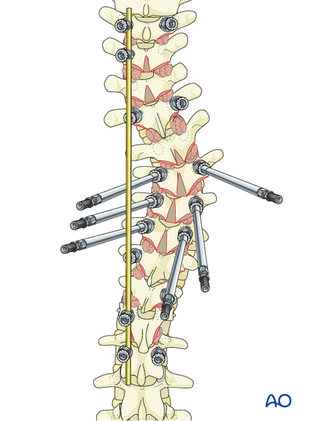 AIS Lenke 1 Posterior pedicle screws - Derotation of the spine